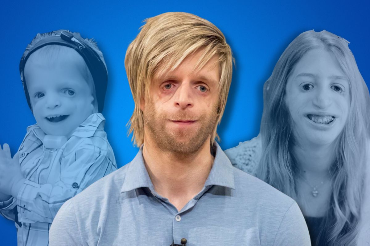 Celebrities with Treacher Collins Syndrome