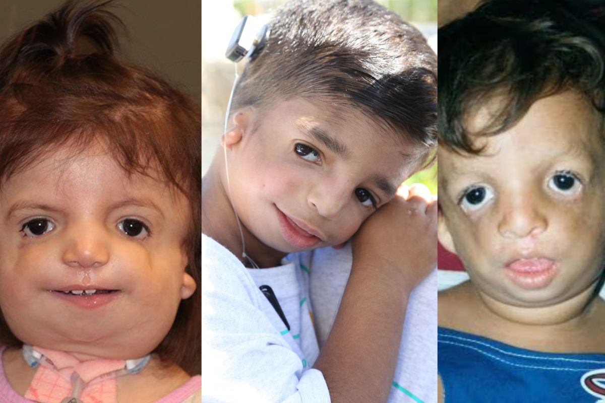 Treacher Collins Syndrome Kids