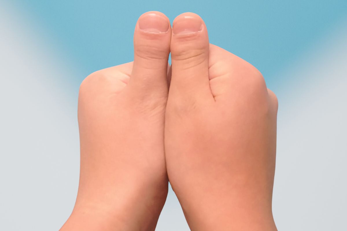 brachydactyly type D