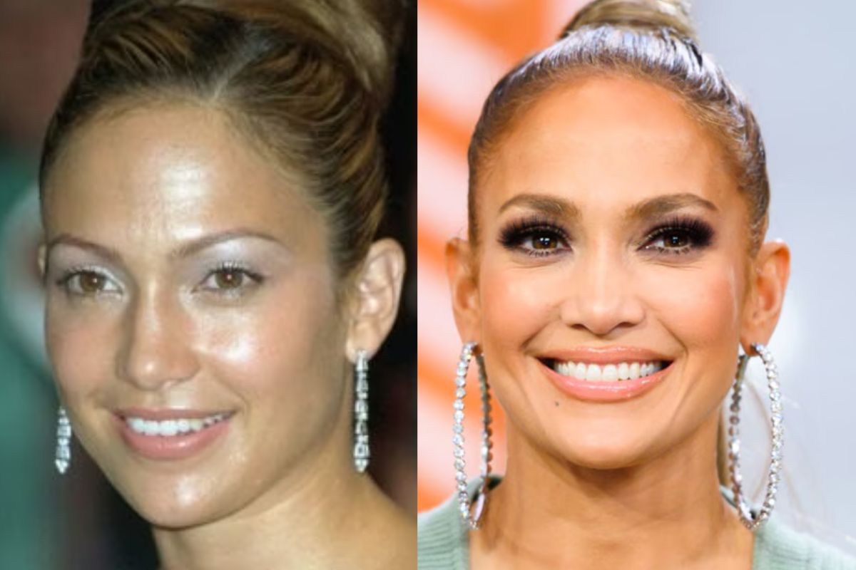Jennifer Lopez nose before after