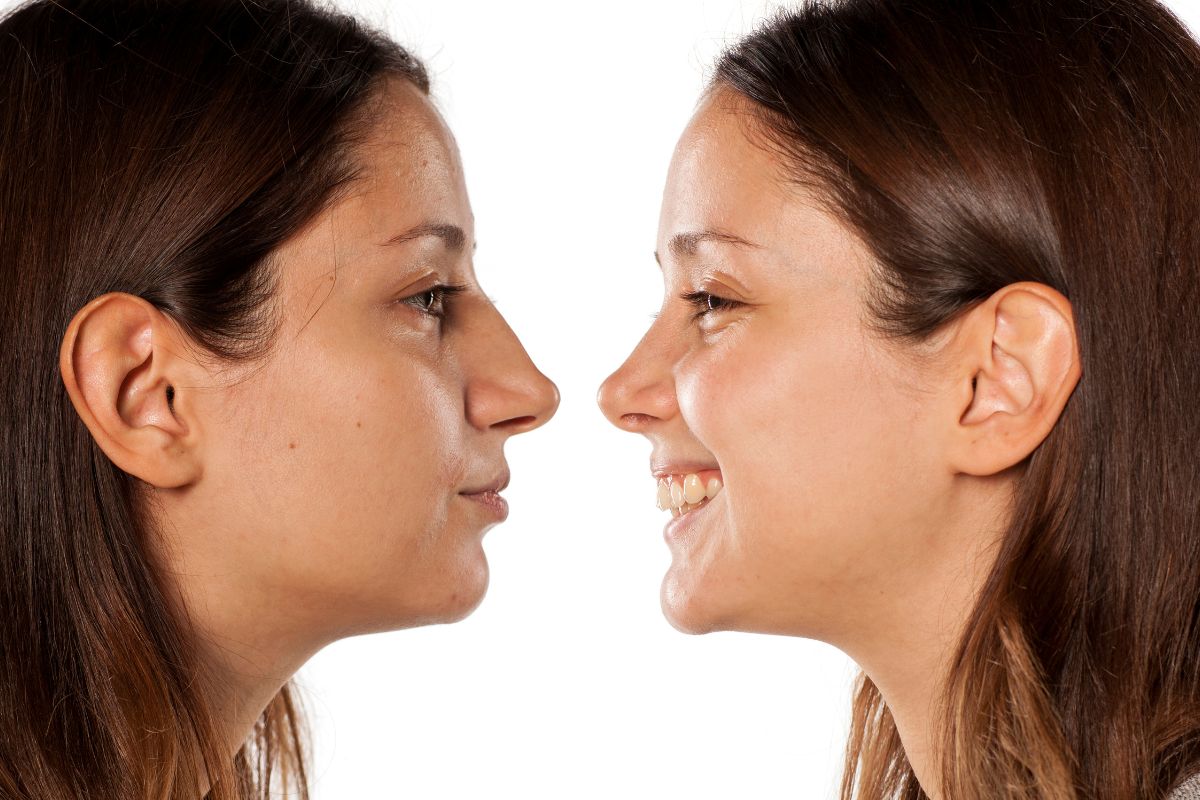 Rhinoplasty