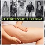 Celebrities with Lipoedema