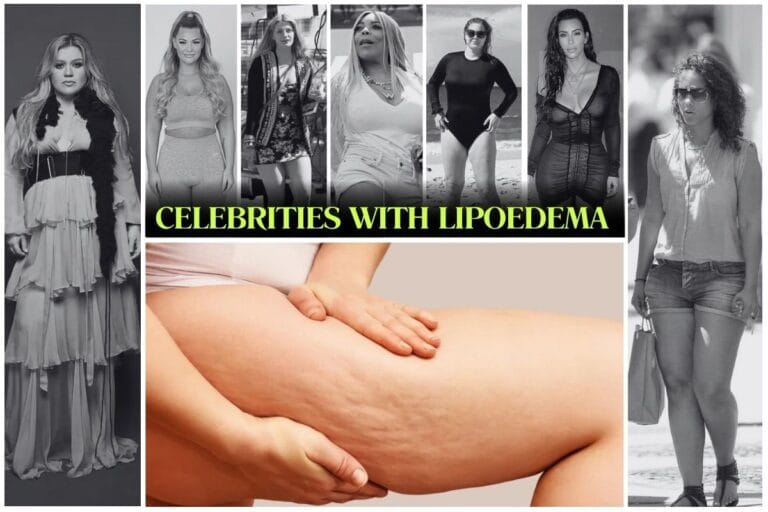 Celebrities with Lipoedema
