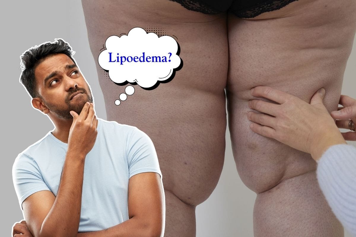 What is Lipoedema